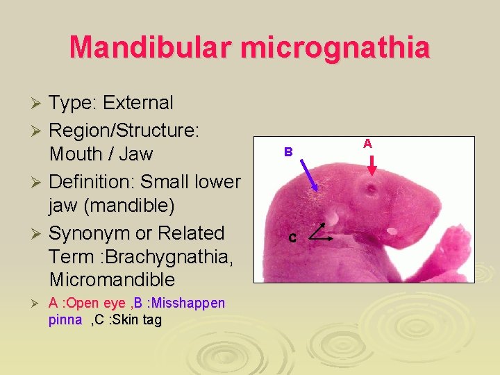 Mandibular micrognathia Type: External Ø Region/Structure: Mouth / Jaw Ø Definition: Small lower jaw