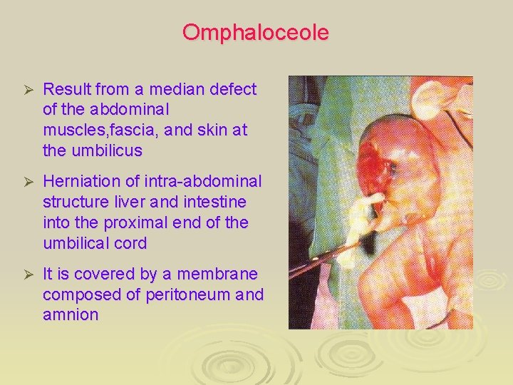 Omphaloceole Ø Result from a median defect of the abdominal muscles, fascia, and skin