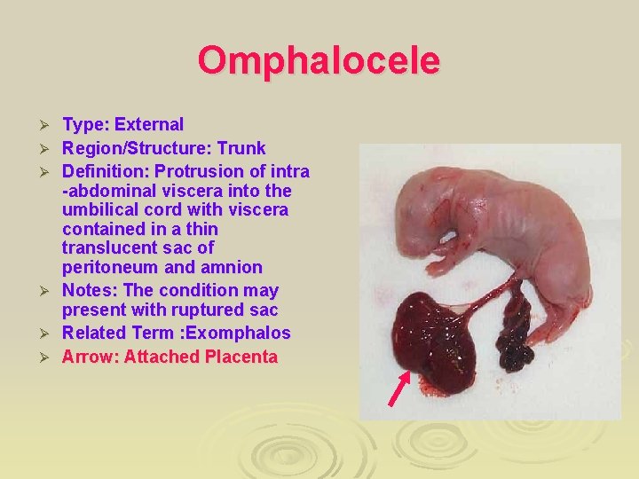 Omphalocele Ø Ø Ø Type: External Region/Structure: Trunk Definition: Protrusion of intra -abdominal viscera