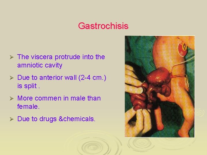 Gastrochisis Ø The viscera protrude into the amniotic cavity Ø Due to anterior wall