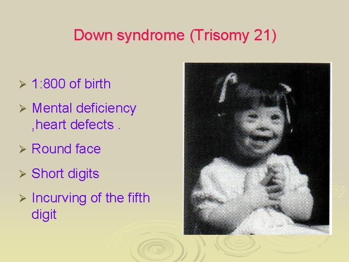 Down syndrome (Trisomy 21) Ø 1: 800 of birth Ø Mental deficiency , heart