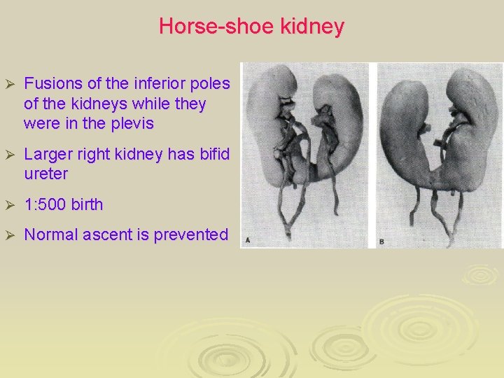 Horse-shoe kidney Ø Fusions of the inferior poles of the kidneys while they were