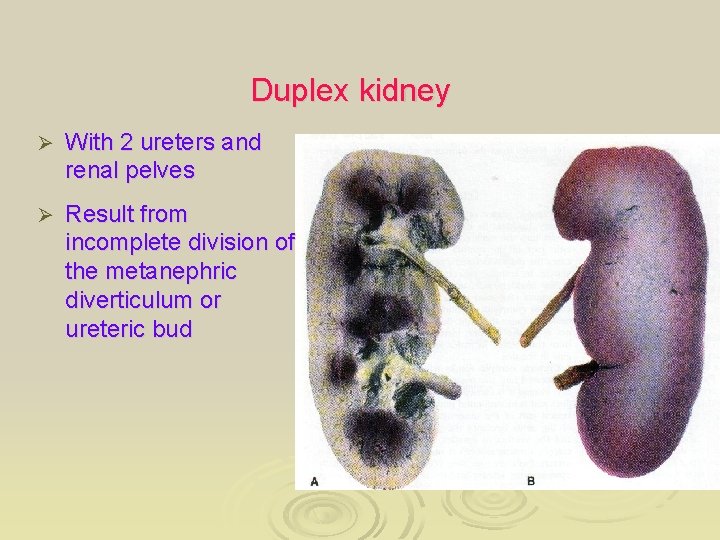 Duplex kidney Ø With 2 ureters and renal pelves Ø Result from incomplete division