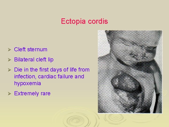 Ectopia cordis Ø Cleft sternum Ø Bilateral cleft lip Ø Die in the first