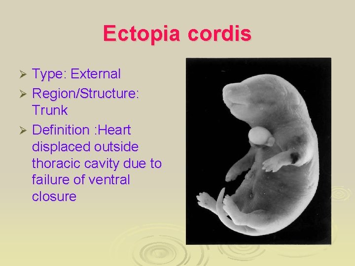 Ectopia cordis Type: External Ø Region/Structure: Trunk Ø Definition : Heart displaced outside thoracic