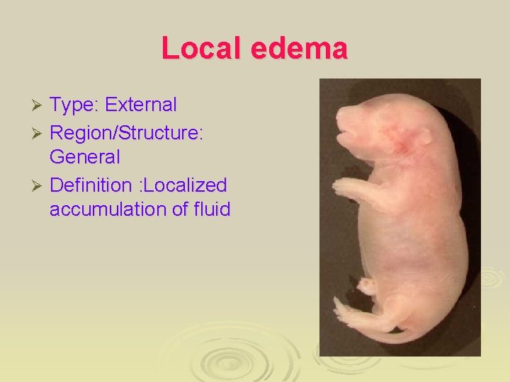 Local edema Type: External Ø Region/Structure: General Ø Definition : Localized accumulation of fluid