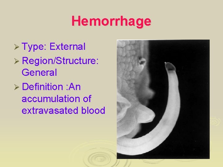 Hemorrhage Ø Type: External Ø Region/Structure: General Ø Definition : An accumulation of extravasated