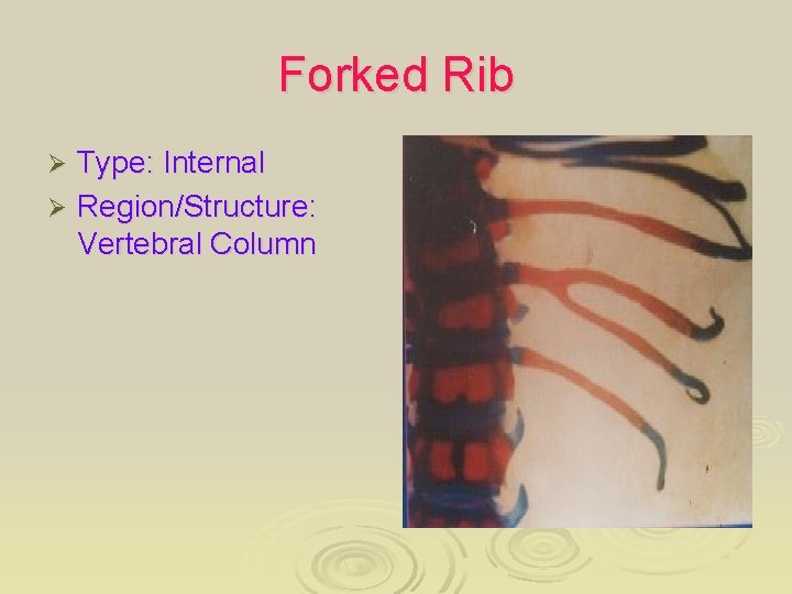 Forked Rib Type: Internal Ø Region/Structure: Vertebral Column Ø 