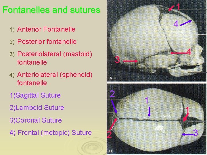 1 Fontanelles and sutures 1) Anterior Fontanelle 2) Posterior fontanelle 3) Posteriolateral (mastoid) fontanelle