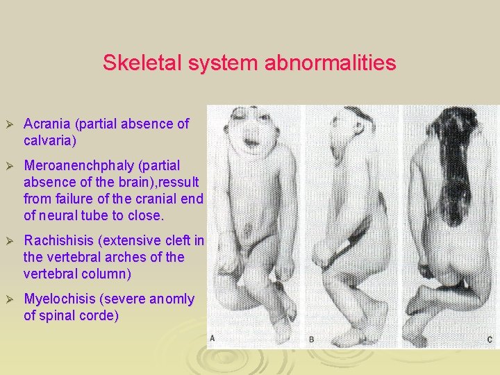 Skeletal system abnormalities Ø Acrania (partial absence of calvaria) Ø Meroanenchphaly (partial absence of