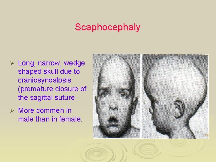 Scaphocephaly Ø Long, narrow, wedge shaped skull due to craniosynostosis (premature closure of the