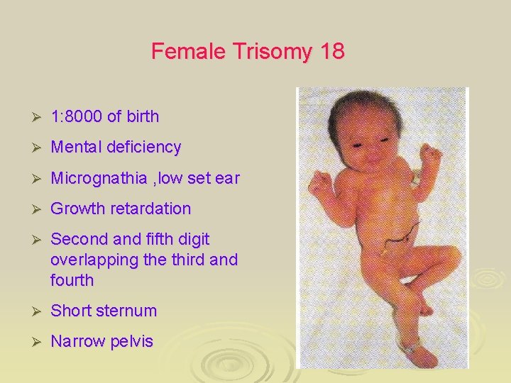 Female Trisomy 18 Ø 1: 8000 of birth Ø Mental deficiency Ø Micrognathia ,