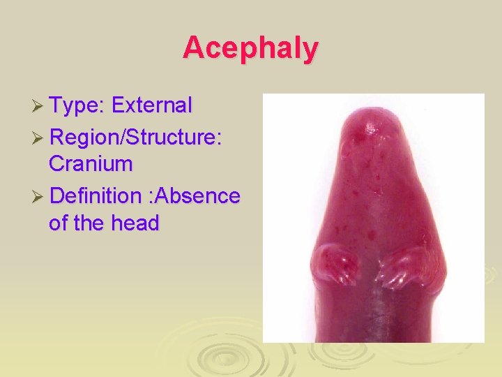 Acephaly Ø Type: External Ø Region/Structure: Cranium Ø Definition : Absence of the head