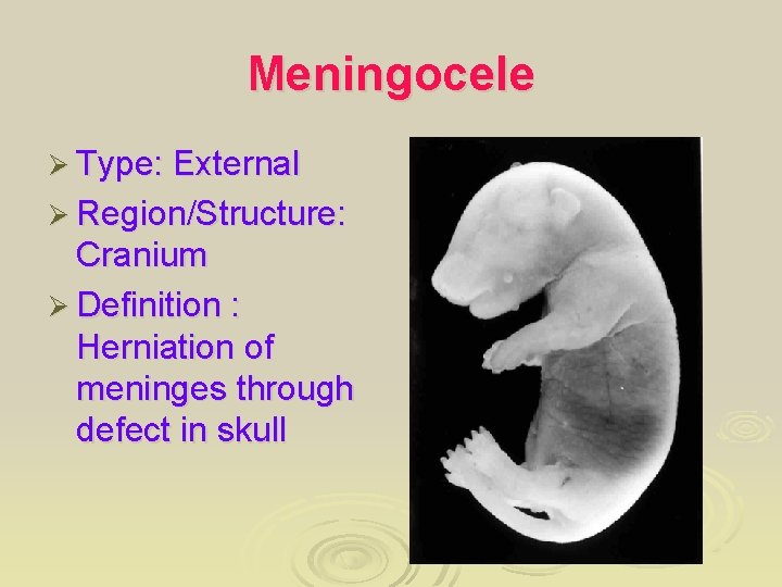 Meningocele Ø Type: External Ø Region/Structure: Cranium Ø Definition : Herniation of meninges through