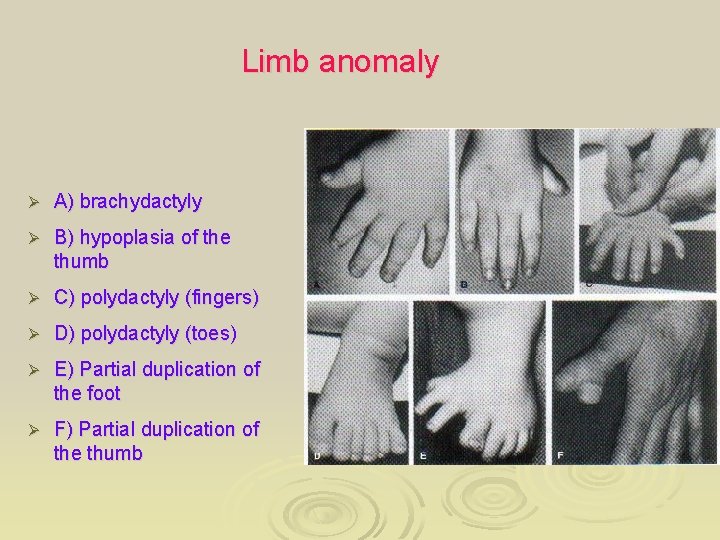 Limb anomaly Ø A) brachydactyly Ø B) hypoplasia of the thumb Ø C) polydactyly