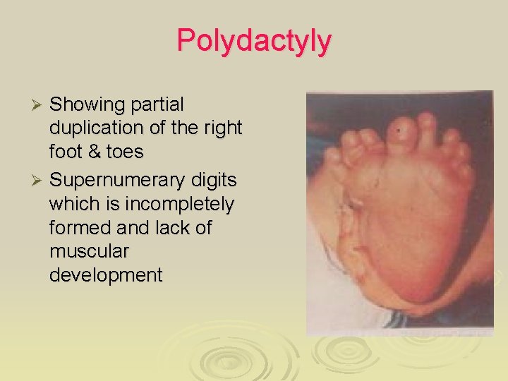 Polydactyly Showing partial duplication of the right foot & toes Ø Supernumerary digits which