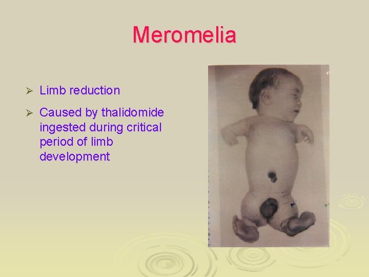 Meromelia Ø Limb reduction Ø Caused by thalidomide ingested during critical period of limb