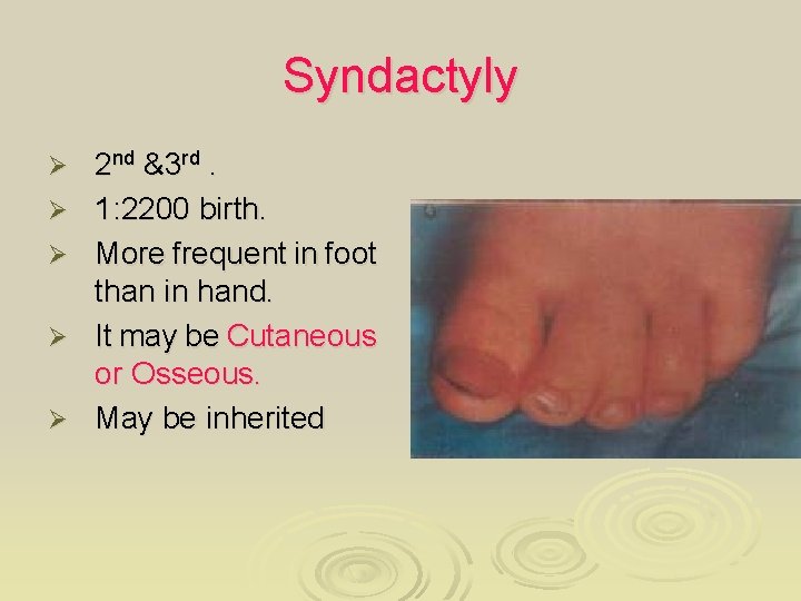 Syndactyly Ø Ø Ø 2 nd &3 rd. 1: 2200 birth. More frequent in