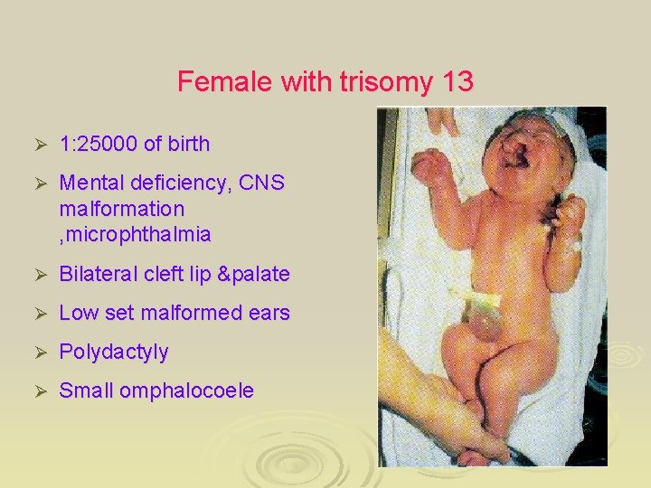 Female with trisomy 13 Ø 1: 25000 of birth Ø Mental deficiency, CNS malformation