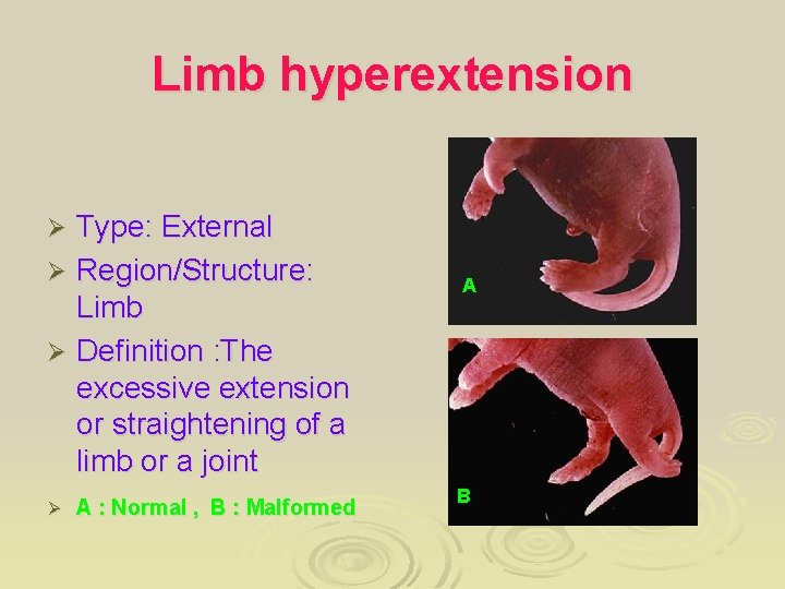Limb hyperextension Type: External Ø Region/Structure: Limb Ø Definition : The excessive extension or