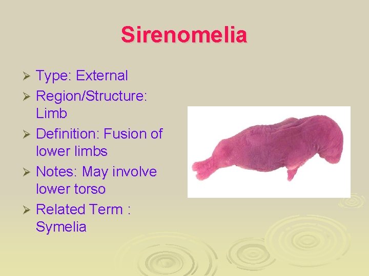 Sirenomelia Type: External Ø Region/Structure: Limb Ø Definition: Fusion of lower limbs Ø Notes: