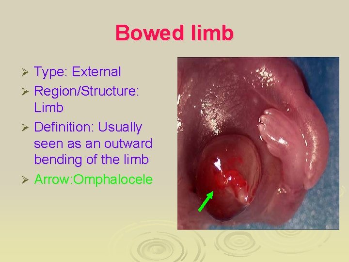 Bowed limb Type: External Ø Region/Structure: Limb Ø Definition: Usually seen as an outward