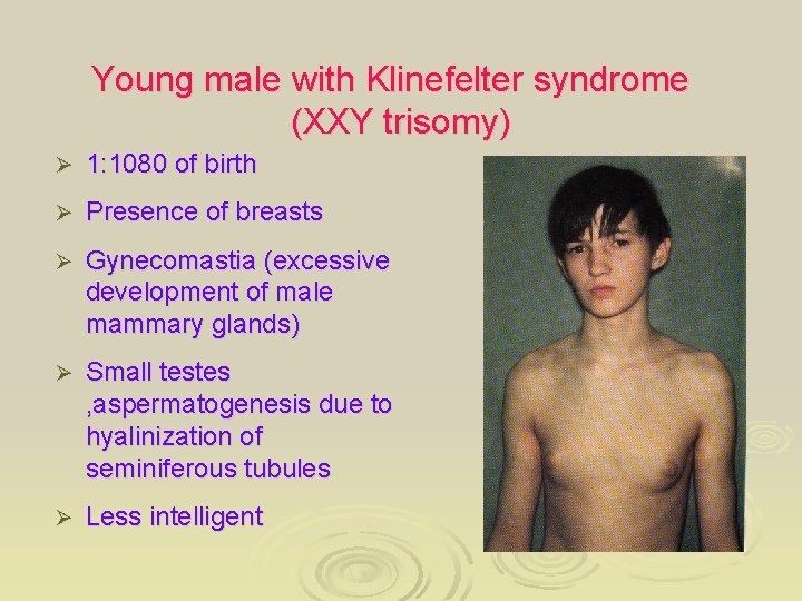 Young male with Klinefelter syndrome (XXY trisomy) Ø 1: 1080 of birth Ø Presence