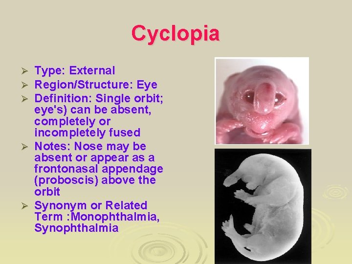Cyclopia Type: External Region/Structure: Eye Definition: Single orbit; eye's) can be absent, completely or