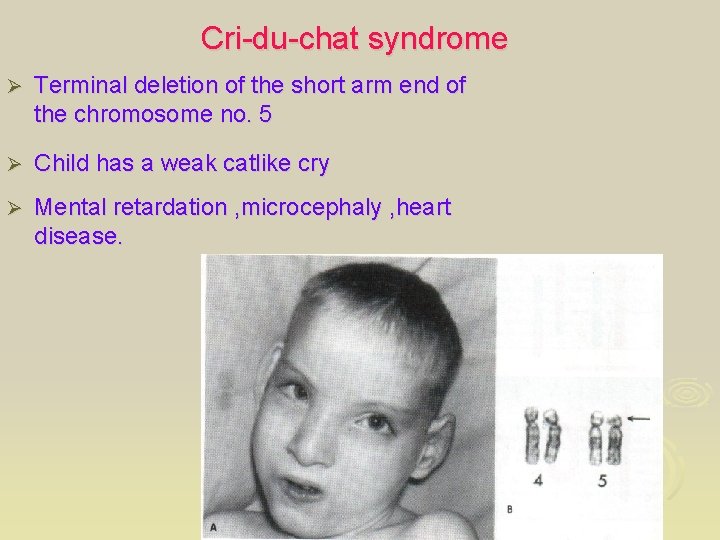 Cri-du-chat syndrome Ø Terminal deletion of the short arm end of the chromosome no.