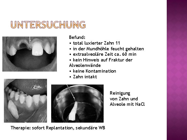 Befund: • total luxierter Zahn 11 • in der Mundhöhle feucht gehalten • extraalveoläre