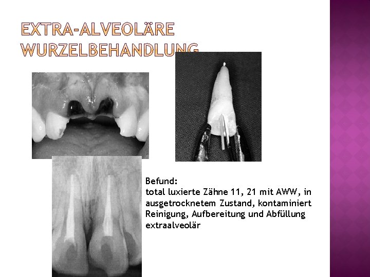 Befund: total luxierte Zähne 11, 21 mit AWW, in ausgetrocknetem Zustand, kontaminiert Reinigung, Aufbereitung