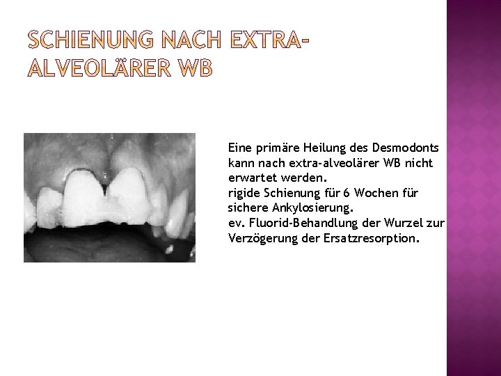 Eine primäre Heilung des Desmodonts kann nach extra-alveolärer WB nicht erwartet werden. rigide Schienung