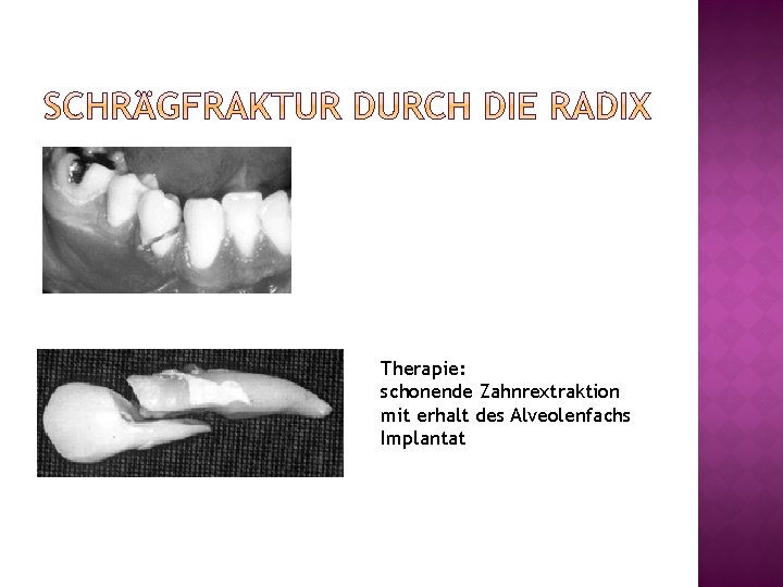 Therapie: schonende Zahnrextraktion mit erhalt des Alveolenfachs Implantat 