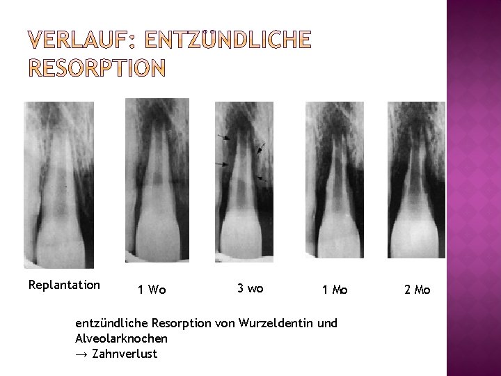 Replantation 1 Wo 3 wo 1 Mo entzündliche Resorption von Wurzeldentin und Alveolarknochen →