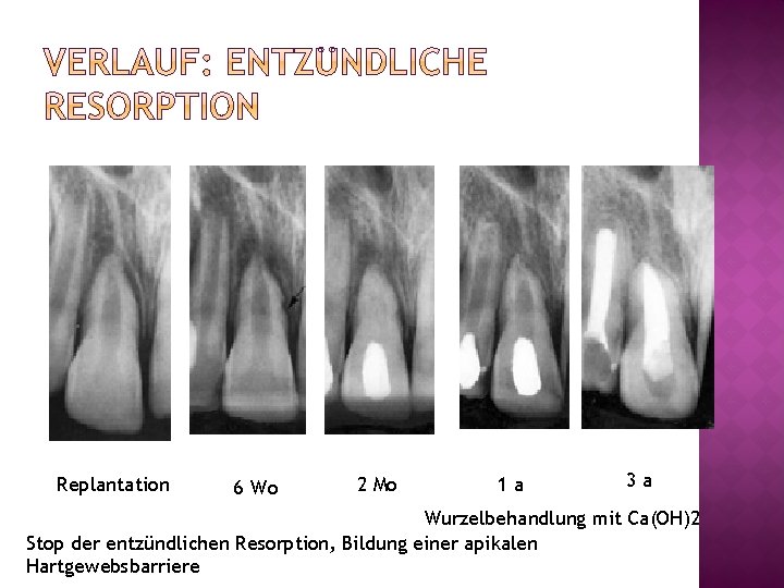 Replantation 6 Wo 2 Mo 1 a 3 a Wurzelbehandlung mit Ca(OH)2 Stop der