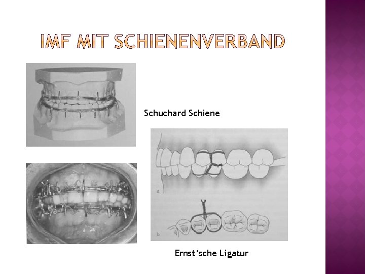 Schuchard Schiene Ernst‘sche Ligatur 