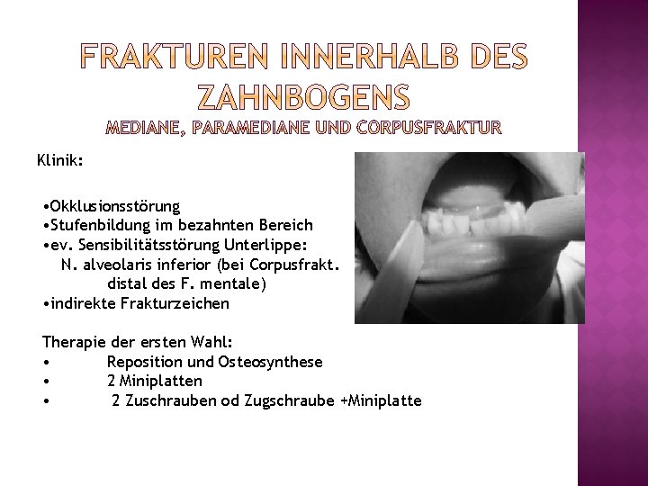 Klinik: • Okklusionsstörung • Stufenbildung im bezahnten Bereich • ev. Sensibilitätsstörung Unterlippe: N. alveolaris