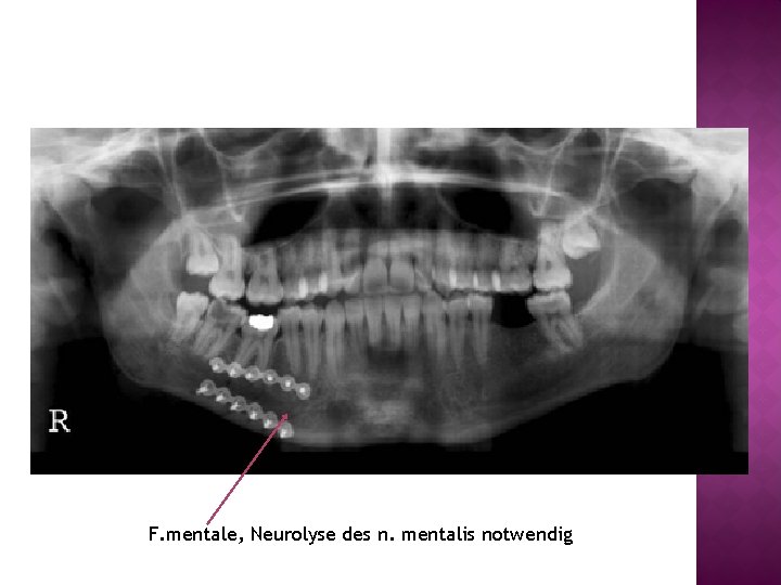 F. mentale, Neurolyse des n. mentalis notwendig 