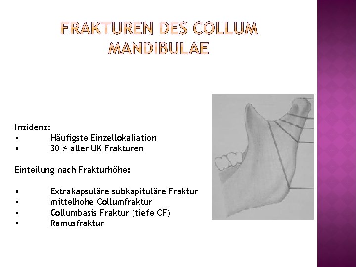 Inzidenz: • Häufigste Einzellokaliation • 30 % aller UK Frakturen Einteilung nach Frakturhöhe: •