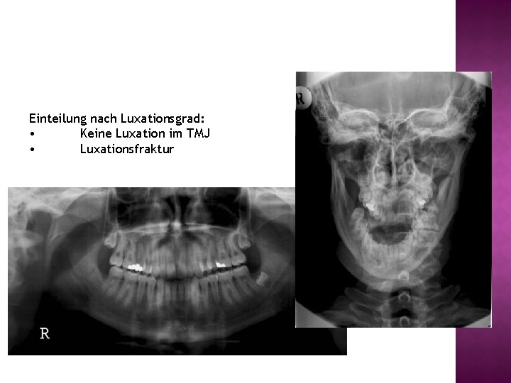 Einteilung nach Luxationsgrad: • Keine Luxation im TMJ • Luxationsfraktur 