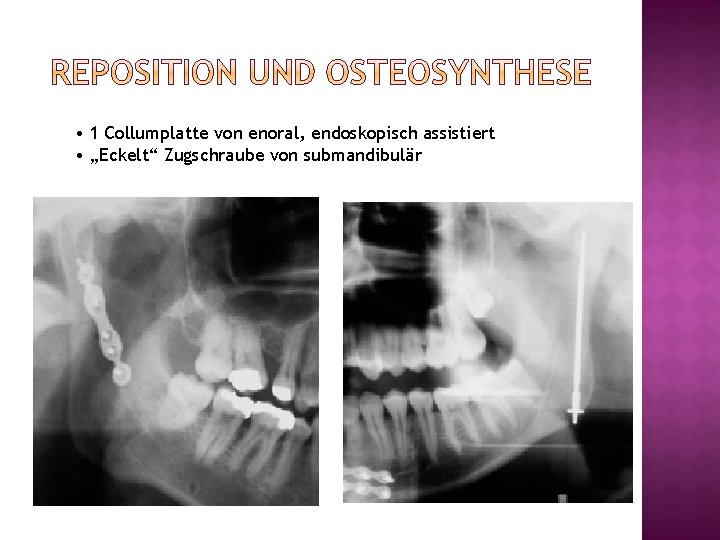  • 1 Collumplatte von enoral, endoskopisch assistiert • „Eckelt“ Zugschraube von submandibulär 