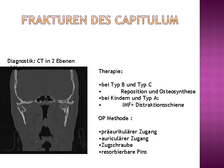 Diagnostik: CT in 2 Ebenen obligat Therapie: • bei Typ B und Typ C