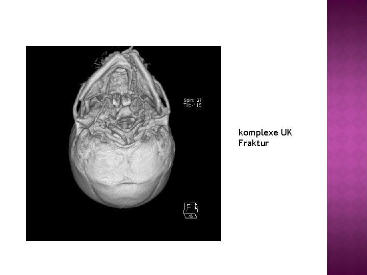 komplexe UK Fraktur 