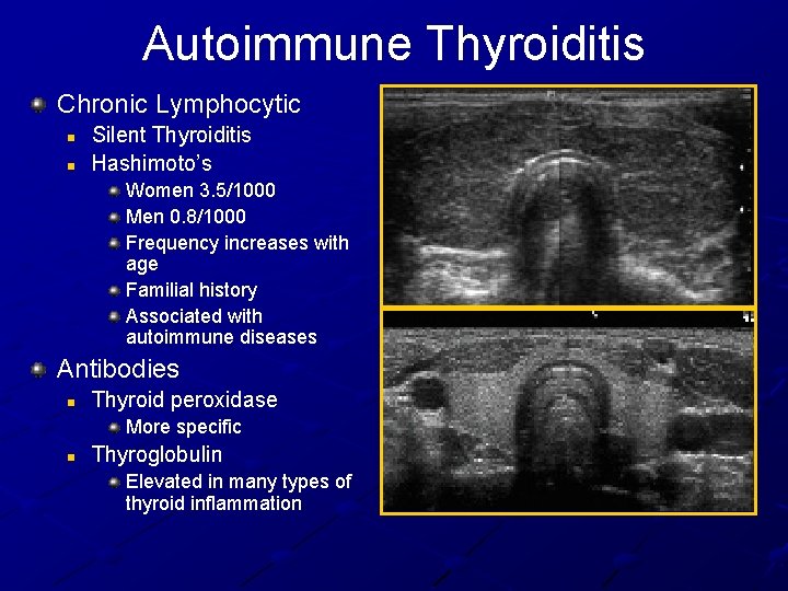 Autoimmune Thyroiditis Chronic Lymphocytic n n Silent Thyroiditis Hashimoto’s Women 3. 5/1000 Men 0.