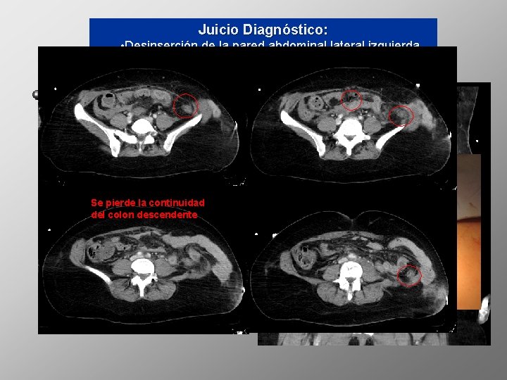 Juicio Diagnóstico: Pregunta 3 • Desinserción de la pared abdominal lateral izquierda de la