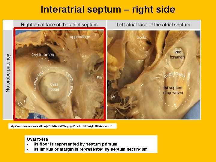 Interatrial septum – right side http: //heart. bmj. com/content/heartjnl/103/6/456/F 2. large. jpg? width=800&height=600&carousel=1 Oval