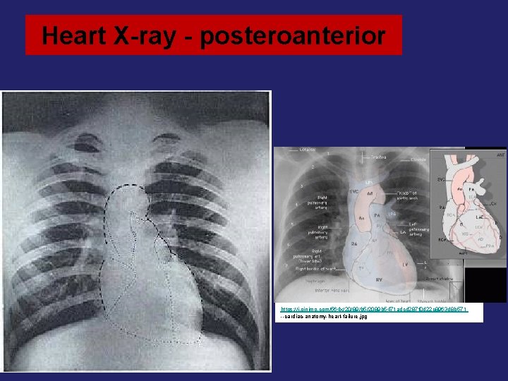 Heart X-ray - posteroanterior https: //i. pinimg. com/564 x/20/89/b 5/2089 b 5471 adcd 287