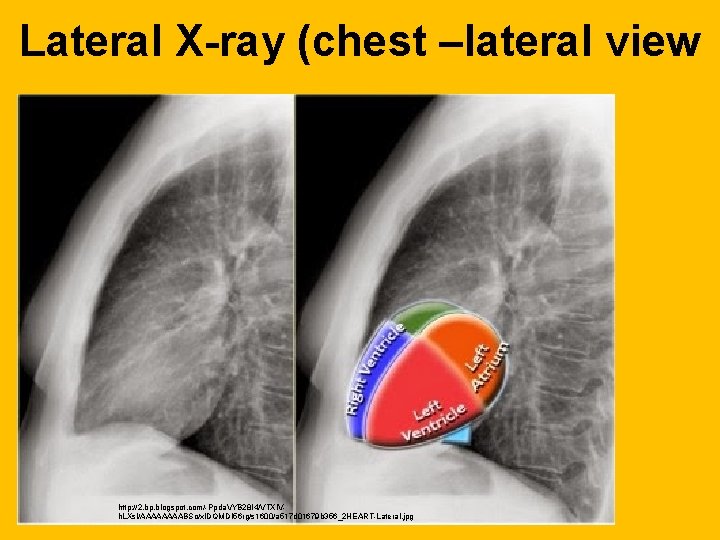 Lateral X-ray (chest –lateral view http: //2. bp. blogspot. com/-Ppda. VYB 28 I 4/VTXIVh.