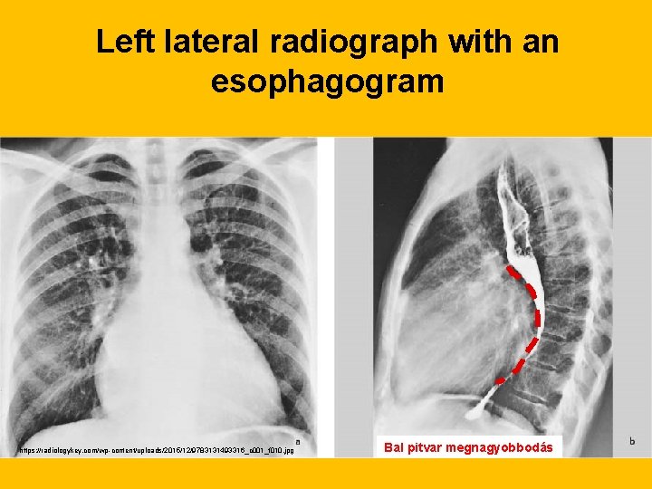 Left lateral radiograph with an esophagogram https: //radiologykey. com/wp-content/uploads/2015/12/9783131493316_c 001_f 010. jpg Bal pitvar