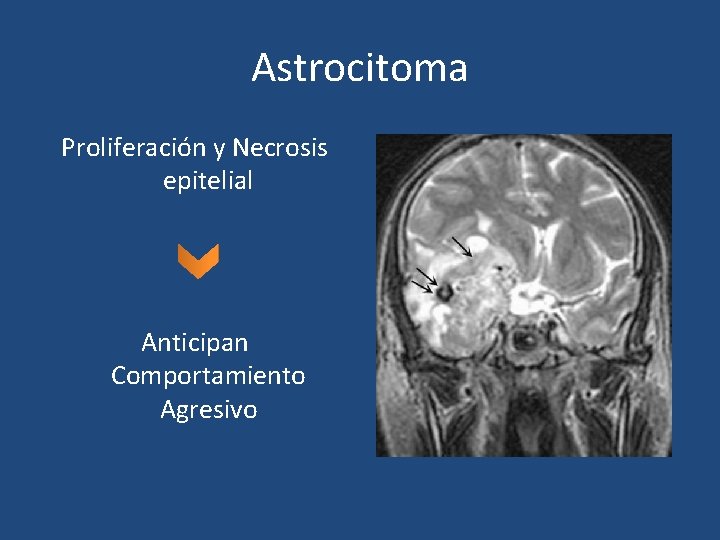 Astrocitoma Proliferación y Necrosis epitelial Anticipan Comportamiento Agresivo 